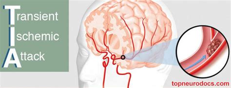 Transient Ischemic Attack Tia Stroke Top Neurodocs