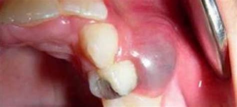 Quiste Maxilar Causas Y Tratamiento Clínica Dental De Terrassa