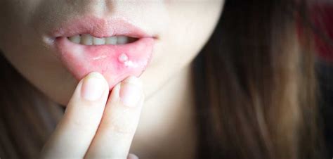 Causes Of Mouth Ulcer In Mouth Ulcers Ulcers Causes Of Mouth Hot Sex Picture