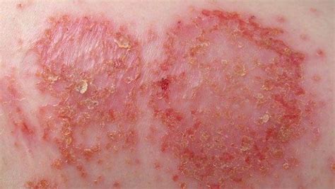Common Skin Disorders In Toddlers And Adults
