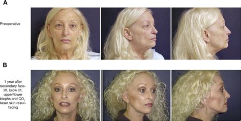 Reoperative Face And Neck Lifts Pocket Dentistry