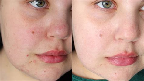 affordable laser treatment for acne scars ipl laser before and after youtube