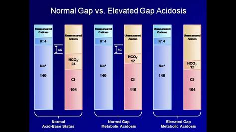 Normal Anion Gap Metabolic Acidosis Justin Miller