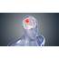 Glioblastoma The Cancer Of Brain  Scientific Animations