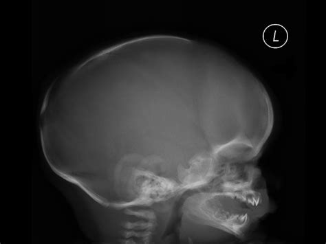 Normal Lateral Skull X Ray