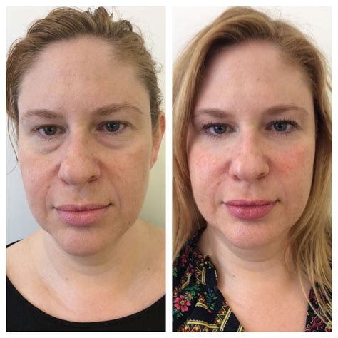 Non Surgical Under Eyes By Dr Rivkin Using Juvederm Juvederm