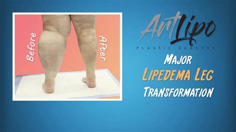 Lipedema Leg Liposuction Results Lipo 360° Cankles And Knees Expert