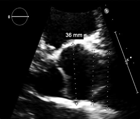 Patent Foramen Ovale Closure Circulation Cardiovascular Imaging