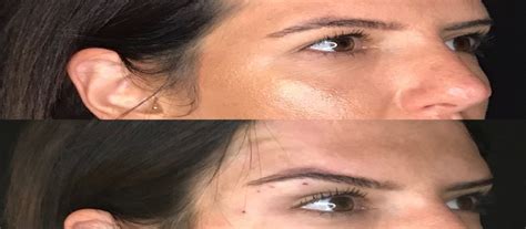What Is Fox Eye Surgery Your Complete Guide To The Fox Eye Lift