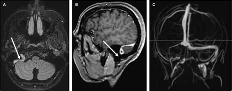 Cerebral Venous Sinus Thrombosis Journal Of Thrombosis And Haemostasis