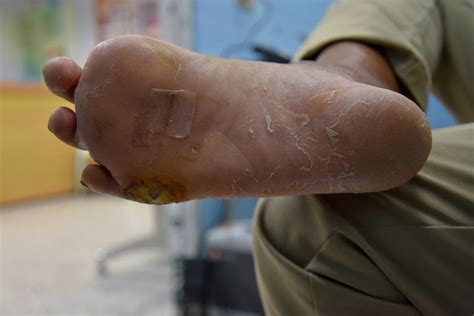 Diabetes Brown Spots On Feet Help Health