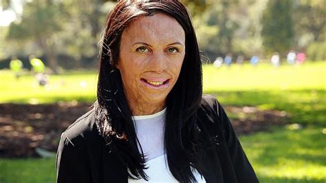 Kimberley Burns Victim Turia Pitt Settles Big Payout Perth Now