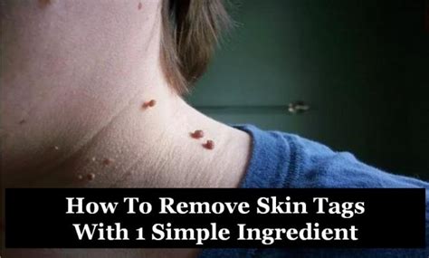 How To Remove Skin Tags How To Instructions