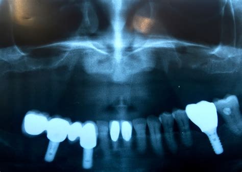 Dental Implants Removed Ryan Lanman Dds Msd