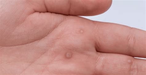 Common Types Of Warts And Their Removal A Listly List