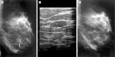 Diagnosis And Treatment Of Breast Fibroadenomas By Ultrasound Guided