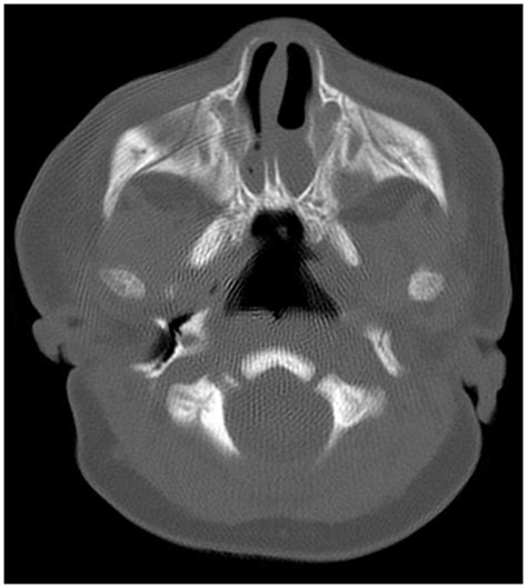 Axial Ct Scan Of The Nasal Cavity In Bone Window At The Level Of