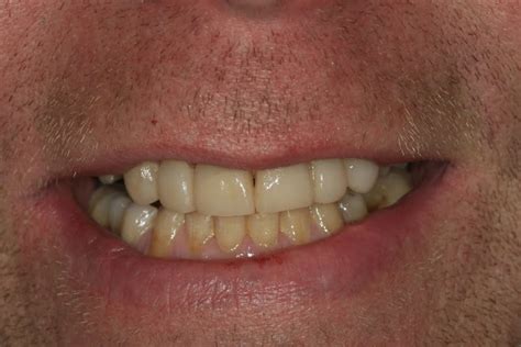 Tooth Coloured Composite Reconstruction Southampton Cosmetic Dentist
