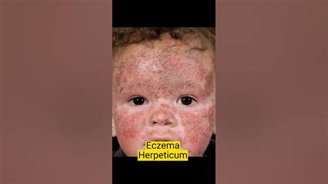 Eczema Herpeticum Herpes Simplex In Atopic Dermatitis Doctor