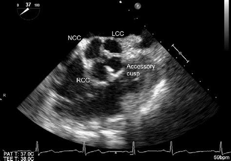 Tee Image Of The Aortic Valve In Short Axis View Demonstrating Four