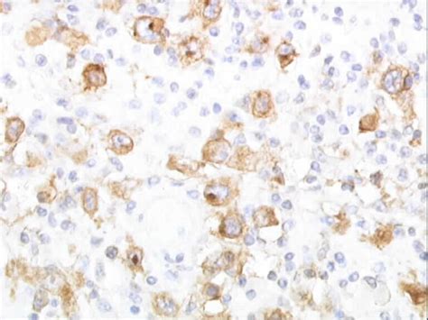 Photomicrograph With Immunohistochemical Staining Showing Cd30 Positive
