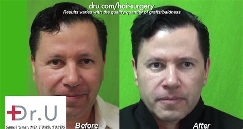 Introduction to facial hair restoration. VIDEO: Facial Hair Restoration By Dr. U In Los Angeles
