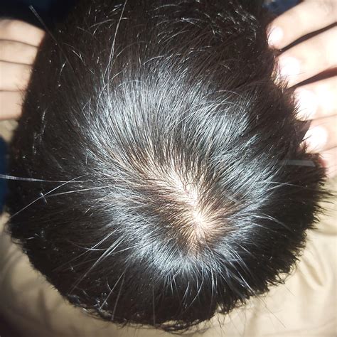 Is This Male Pattern Baldness At 18 Or Is It Because Of My Scratching