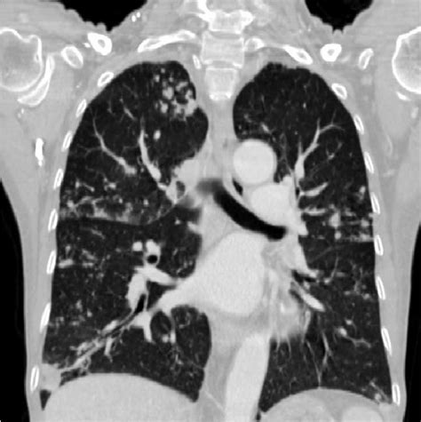 High Resolution Chest Ct Shows Extensive Bronchiectasis And Clustered