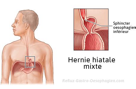Hernie hiatale description symptômes complications causes traitement Reflux gastro