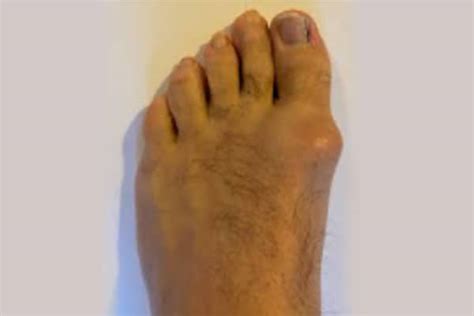 Foot Deformities Foot Focus Podiatry Perth Podiatrists