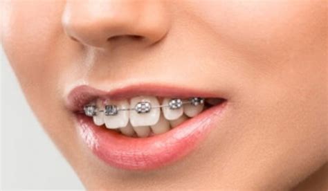How To Fix An Overbite With Braces Transits Blog