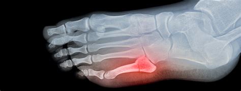 What You Should Know About A Broken Pinky Toe Orthopedic And Sports