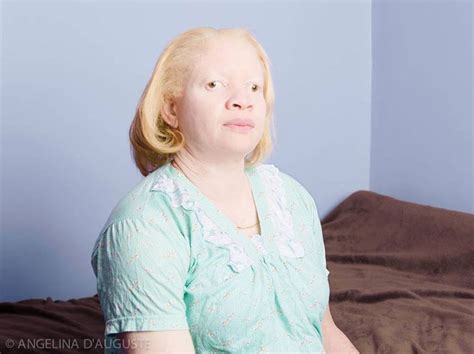Albinizm Przyczyny