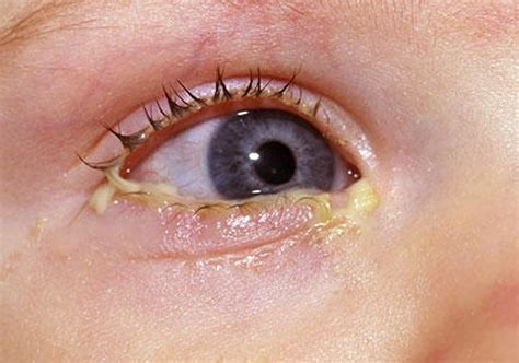 Mucus In Eye Types Pictures Home Remedies Yellow Mucus