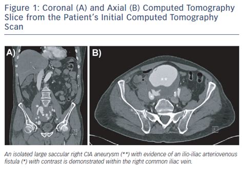 Coronal A And Axial B Computed Tomography Slice From The Patients
