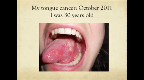 What Causes Tongue Cancer Smoking Drinking Sex Kissing Youtube