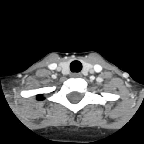 Normal Ct Of The Neck Radiology Case