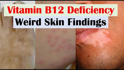 Vitamin B Deficiency Weird Skin Findings Hair And Nails Youtube