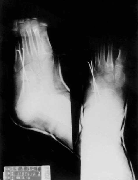 Figure 2 From The Nutcracker Fracture Of The Cuboid In Children A Case