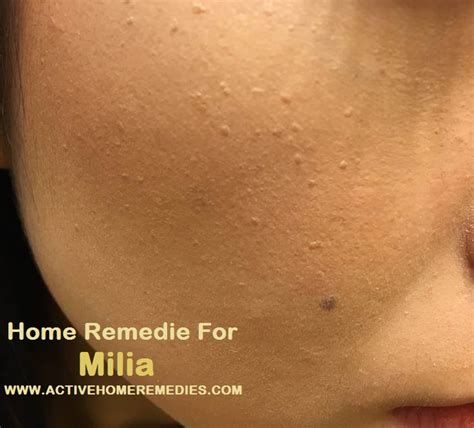 Home Remedies For Milia On Face Israel Style
