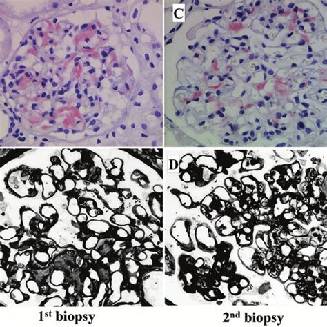 A B Specimens From The First Renal Biopsy Light Microscopic