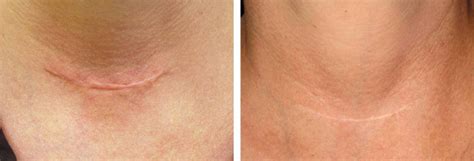 Laser For Scar Removal Insight Derma Clinic