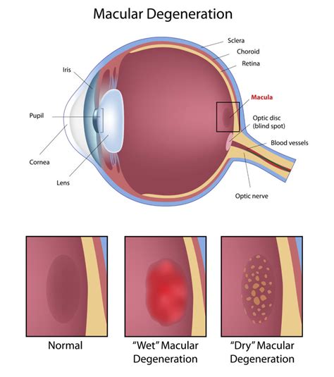 Macular Degeneration Eye Associates Of Tucson Eye Care Tucson Eye