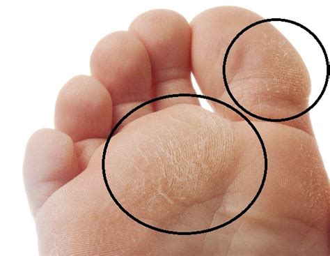 Callus Removal Symptoms Causes Treatment Feet Pictures Healthmd