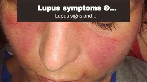Lupus Symptoms And Treatments Fundamentals Explained
