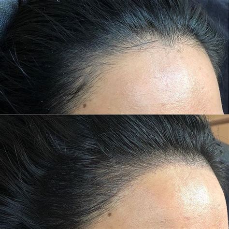 Prices start at aed 2,250/sar 2,298. Gold Permanent Makeup Scalp Microblading - Gold Permanent ...