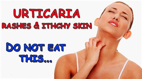 Itchy Skin And Rashes Urticaria Avoid High Histamine Foods Youtube