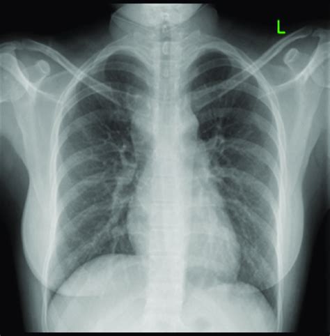 Chest Radiograph Posteroanterior View Chest X Ray Posteroanterior