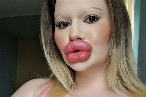 Woman With World S Biggest Lips Warned They Ll Burst As She Gets