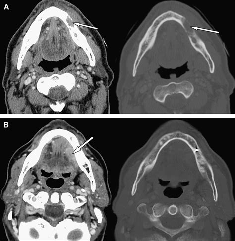 Oral Cavity And Oropharynx Tumors Radiologic Clinics